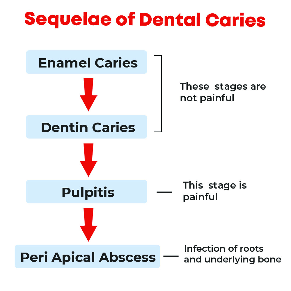 dental-caries.jpg