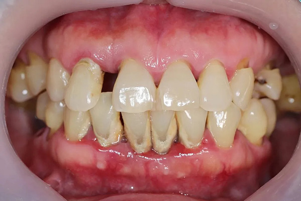 periodontis-2.jpg