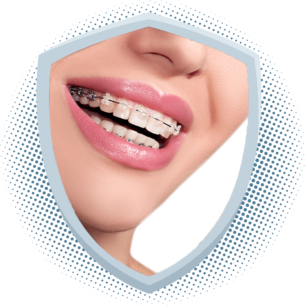 Fast-braces-dr-praveens-dental-kukatpally